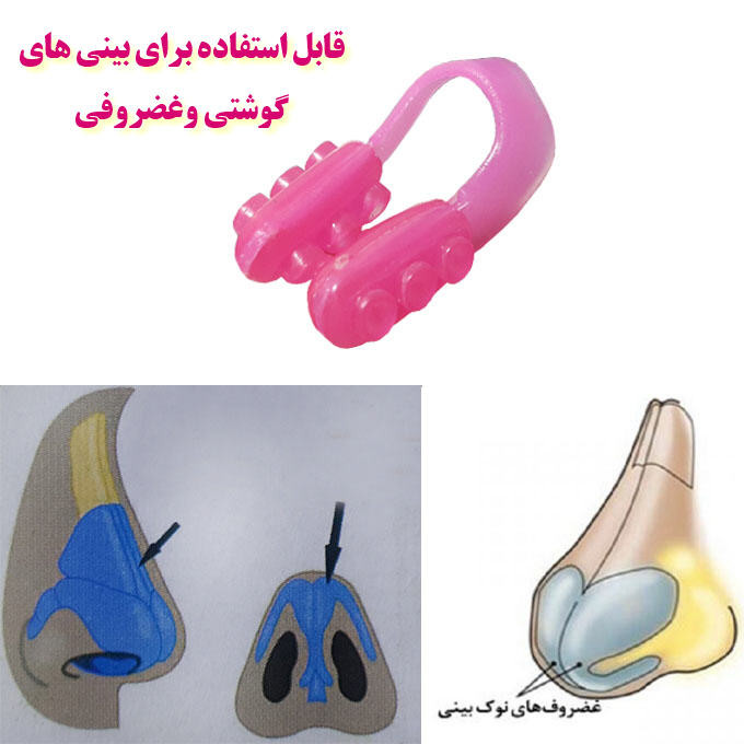 گیره کوچک کننده بینی