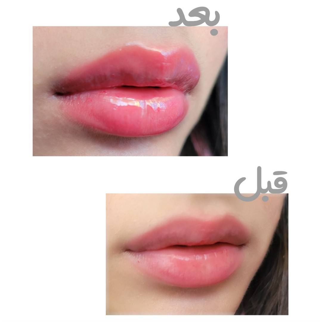 پروتز لب