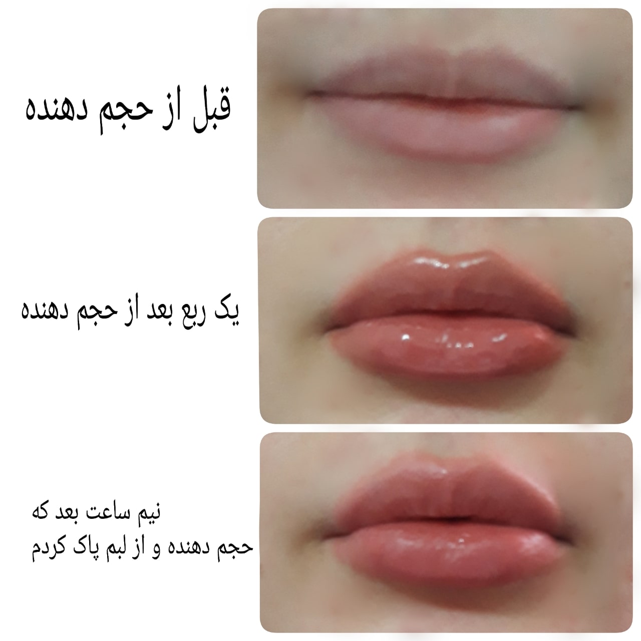 فیلر لب